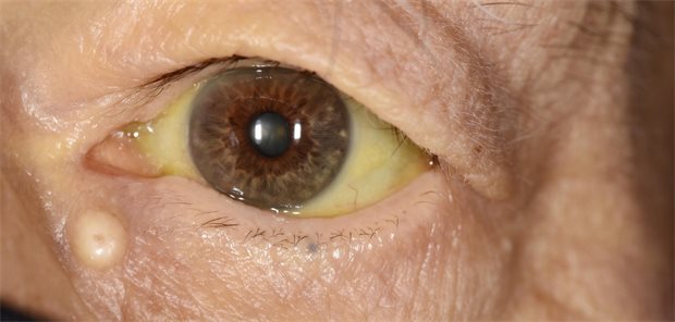 Tipps zur Früherkennung: Warnzeichen für Pankreaskrebs erkennen Sklerenikterus bei einem älteren Patienten