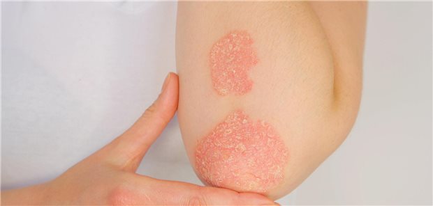 Nahaufnahme des Ellenbogenbereiches einer Frau, die an Psoriasis erkrankt ist, mit großem roten schuppigen Ausschlag.