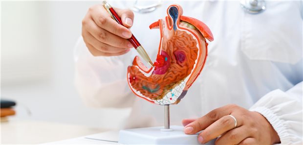Fall-Kontroll-Studie: Langzeittherapie mit PPI geht nicht mit Magenkrebs einher Ein Gastroenterologe verwendet ein anatomisches Modell des menschlichen Magen, um einem Patienten während einer Konsultation in der Klinik die Diagnose und die Behandlungsmöglichkeiten zu erklären.