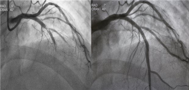 Die Autorinnen und Autoren resümieren, dass die Ergebnisse der randomisierten klinischen Studie zeigen, dass QCA- und IVUS-gesteuerte perkutane Koronarinterventionen nach zwölf Monaten ähnliche Raten für Fehlschläge an der Zielläsion aufweisen.