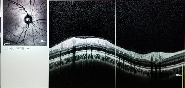 Blick auf einen Sehnerv mittels Optischer Kohärenztomografie