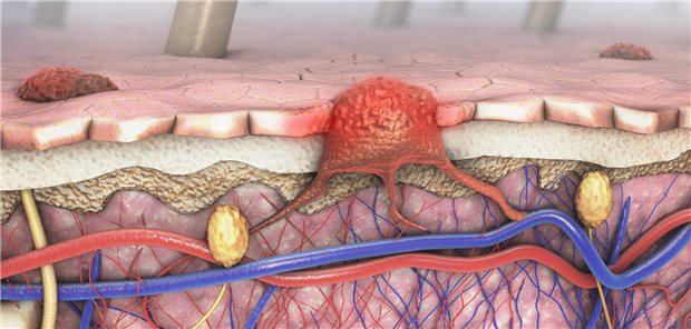 Die Autorinnen und Autoren resümieren, dass ihre Ergebnisse nahe legen, dass die Überlebenskurven von Menschen mit fortgeschrittenen Melanomen, die unter Alltagsbedingungen mit Immun-Checkpoint-Inhibitoren (ICI) behandelt werden, eine Plateauphase erreichen, so wie das in klinischen Studien mit ICI der Fall war.