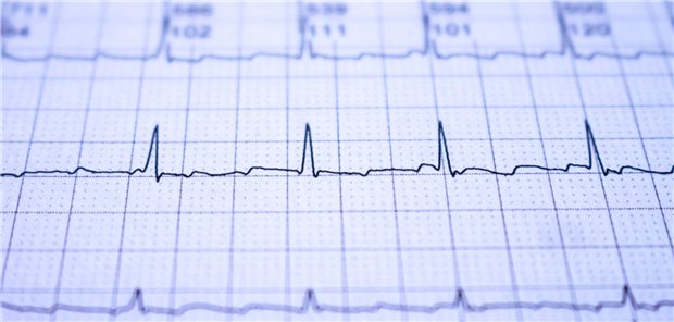 Beispielhafter EKG-Ausschnitt