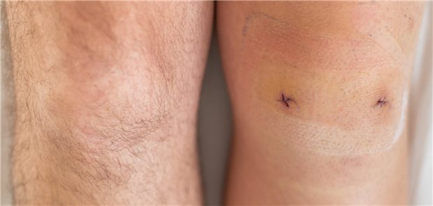 Studie: Operation bei degenerativem Meniskusschaden ohne Langzeitnutzen Nahaufnahme des rechten und linken Knie eines Mannes nach einer laparoskopischen Minisk-Operation.