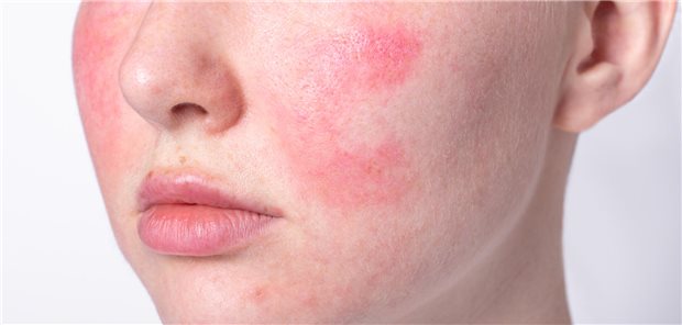 Rosazea: Vagusnervstimulation womöglich bei Couperose wirksam Die Couperose, deren Merkmal Rötungen und erweiterte Äderchen im Gesicht sind, gilt als Vorstufe der schweren, entzündlichen Rosazea. Betroffene spüren einen hohen Leidensdruck. (Symbolbild)