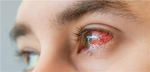 Pilzkeratitis: CRISPR-Test hilft bei unklaren Verdachtsfällen Rotes Auge aufgrund einer infektiösen Hornhautentzündung.