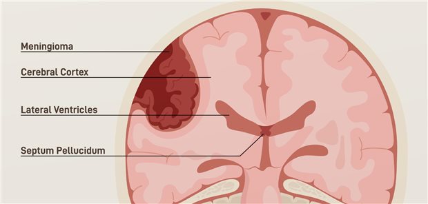 Die Forscherinnen und Forscher um Noémie Roland resümieren, dass der prolongierter Gebrauch von Medrogeston, Medroxyprogesteron und Promegeston das Risiko für intrakraniale Meningeome erhöhe.