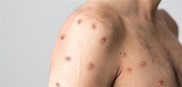 Mpox weitet sich in Berlin auf weitere Personengruppen aus MPOX-Läsionen bei einem Mann.