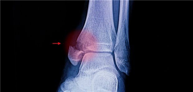 Eine X-ray-Aufnahme einer Fraktur des Sprunggelenks.