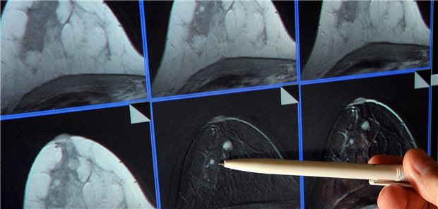 Leitliniengerecht auf Brustkrebs screenen: Auch ältere Frauen profitieren Eine Person zeigt mit einem Kugelschreiber auf Bilder eines Brust-Scans.