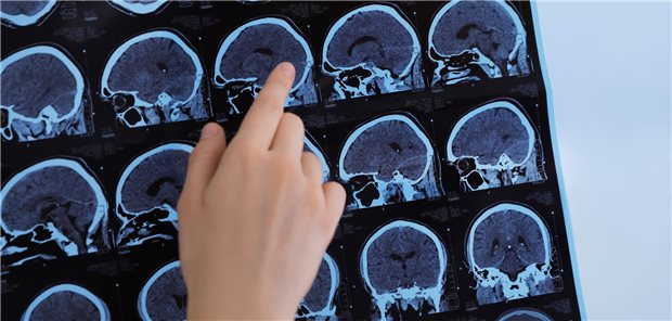 Benigne Multiple Sklerose bleibt wohl meist langfristig stabil Nahaufnahme wie ein Arzt die MRT-Bilder eines Patienten mit Multipler Sklerose untersucht.