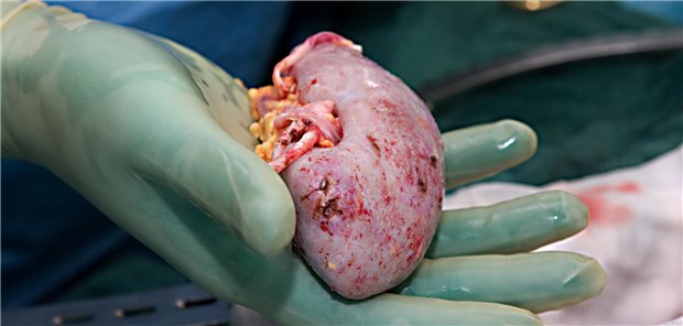 Niere eines Organspenders