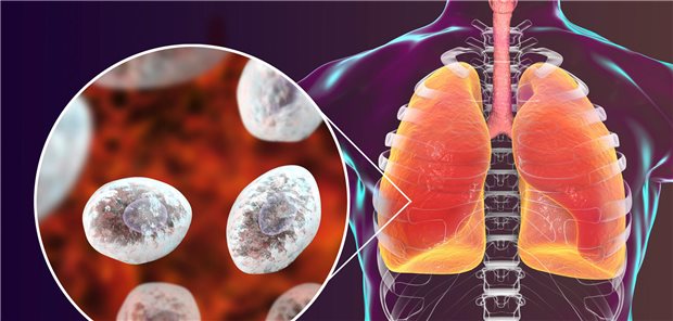 Die Pneumocystis-jirovecii-Pneumonie war in einer aktuellen Studie die häufigste Pilzerkrankung bei Menschen mit Autoimmunerkrankungen.