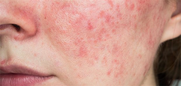 Topische Rosazea-Therapien im Vergleich: Was wirkt am besten? Rosacea-Rötungen auf der Wange einer Patientin.