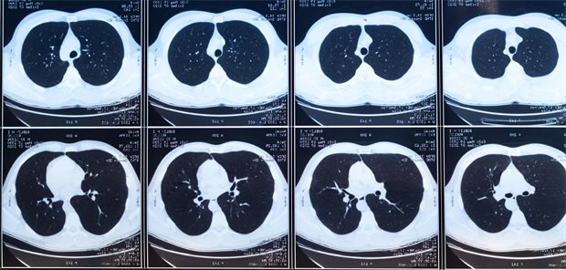 Lungenkrebs-Screening: Große Unterschiede bei der Bildinterpretation CT Aufnahmen zur Diagnose von möglichen Erkrankungen der Atemwege.