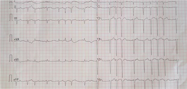 Aufnahme eines EKG, das Vorhofflimmern zeigt.