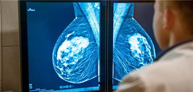 KI sieht Suspektes in Mammografie-Serien schon zehn Jahre vor dem Menschen Ein Arzt betrachtet auf zwei Monitoren die Mammographieaufnahme der Brust einer Patientin.