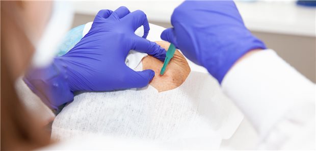 Lokalisiertes Melanom: Sechs Merkmale deuten auf erhöhtes Rezidivrisiko hin Eine Dermatologin entfernt eine Hautveränderung im Gesicht eines älteren Patienten.