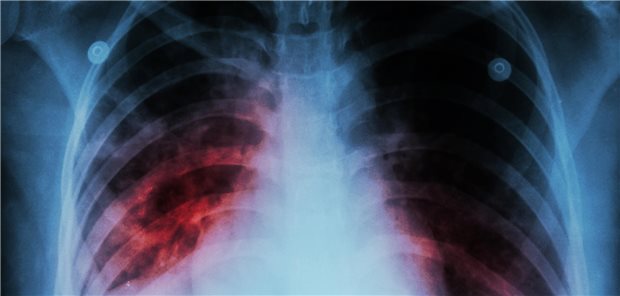 Diskriminierungsfreie Sprache in der Tuberkulose-Prävention: Handlungsempfehlungen für Ärztinnen und X-Ray der Lunge einer von Tuberkulose betroffenen Person.