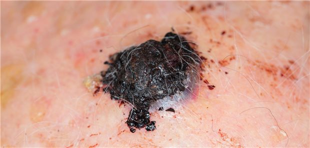 Bietet die Wächterlymphknotenbiopsie beim Melanom Überlebensvorteile? Ein malignes Melanom auf dem Kopf eines Mannes.