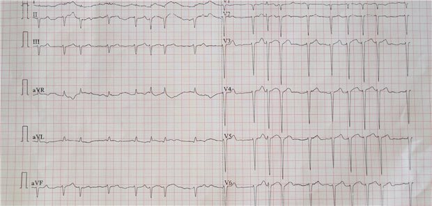 Abbildung eines EKG