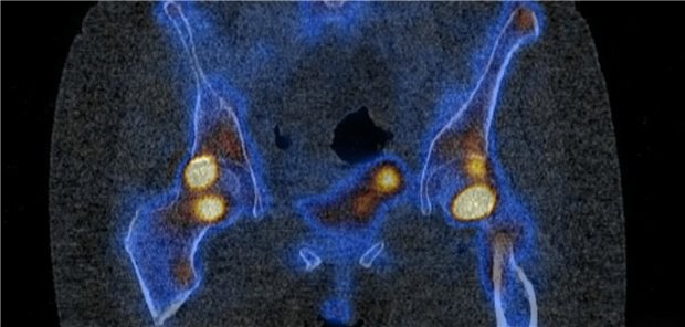 Eisenmangel: Wahl des Eisenpräparats beeinflusst das Frakturrisiko Skelettszintigraphie einer betroffenen Patientin mit Osteomalazie in den Hüften (gelb) nach intravenöser Eisentherapie mit Eisencarboxymaltose.
