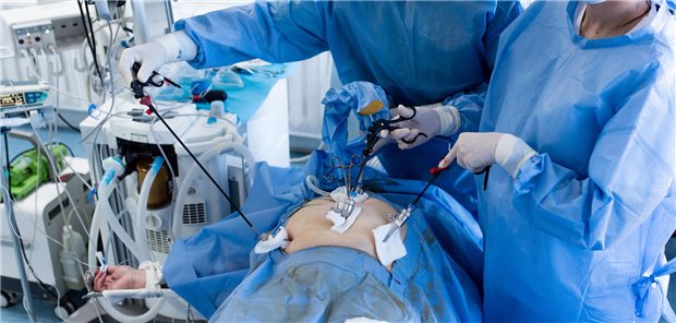 Hemikolektomie: Offenbar schnellere Heilung mit intrakorporaler Darm-Anastomose Chirurgen mit Latexhandschuhen und blauen Uniformen führen eine laparoskopische minimalinvasive Bauchoperation an einem Patienten mit speziellen medizinischen Instrumenten durch.