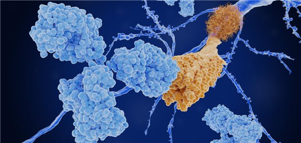 „Disease Mongering“ und „fragwürdiger Nutzen“: DEGAM kritisiert Empfehlungen zu Alzheimer Amyloid-Ablagerungen an Neuronen.