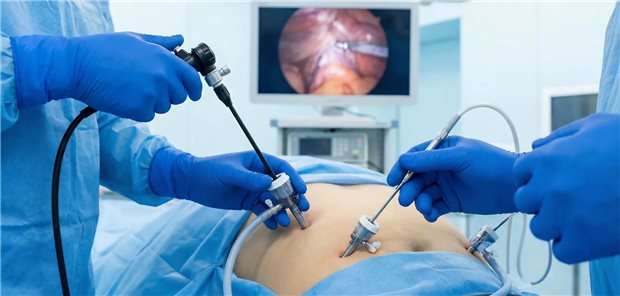 Morbus Crohn: Wann eine frühe Operation von Vorteil ist Aufnahme einer Laparoskopie mit Trokaren bei einem Patienten im Operationssaal