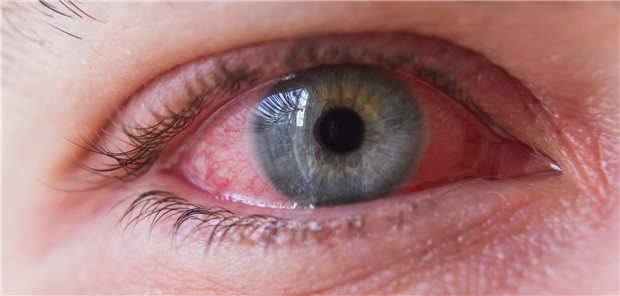 Augen-Rosazea: Erst sind’s die Lider, später auch die Hornhaut Makro-Nahaufnahme eines Auges mit okulärer Rosazea.