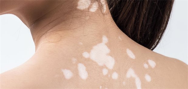 Vitiligo: Tipps für ein optimales Therapiemanagement Eine Frau mit segmentalen Vitiligo-Flecken auf dem Rücken.