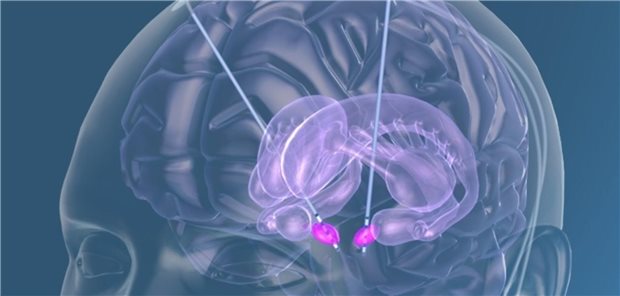 Parkinson: Gleichstromstimulation könnte Nutzen der tiefen Hirnstimulation vorhersagen Tiefe Hirnstimulation.