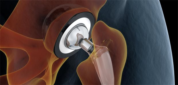 Schützt die Hüft-TEP mit Dual-Mobility-Technik vor Luxationen? Medically accurate illustration of the hip replacement. 3d illustration.