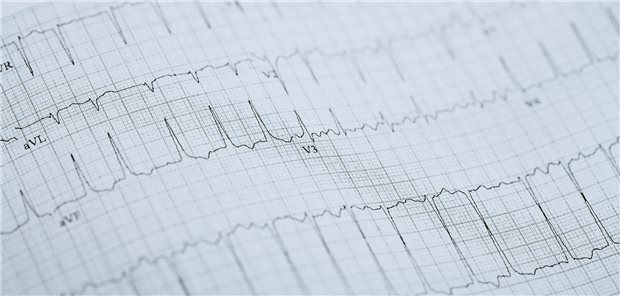 Rhythmuskontrolle bei Vorhofflimmern: Wann initiieren? EKG eines Patienten mit Vorhofflimmern-Symptomen