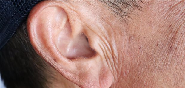 Komplikationen: Hörverlust kann auf diabetische Mikroangiopathie hinweisen Nahaufnahme der rechten Ohrmuschel eines Mannes.