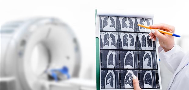 Studie: Zufallsbefunde beim Lungenkrebs-Screening deuten auf Krebs hin Ein Radiologe, der die Computertomographieaufnahme der Lunge eines Patienten betrachtet.