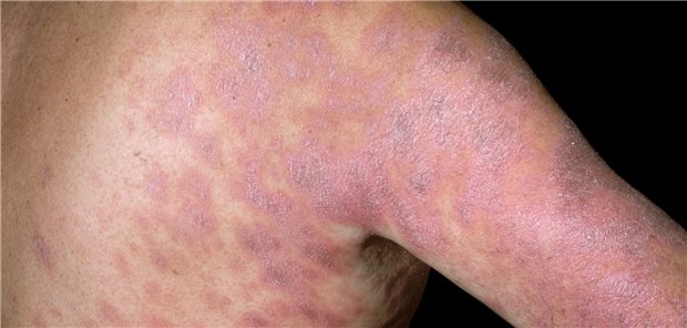 Nesselsucht nach Tabletten-Einnahme: Wie Sie bei Arzneimittel-Allergien vorgehen sollten Ein durch eine Arzneimittel-Allergie ausgelöstes Exanthem bei einem 46-jährigen