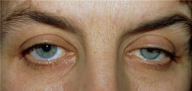 Hängendes Augenlid – Schauen Sie auch auf die Pupillen! Horner Syndrom mit hängendem Augenlid und kleiner Pupille bei einem jungen Mann.