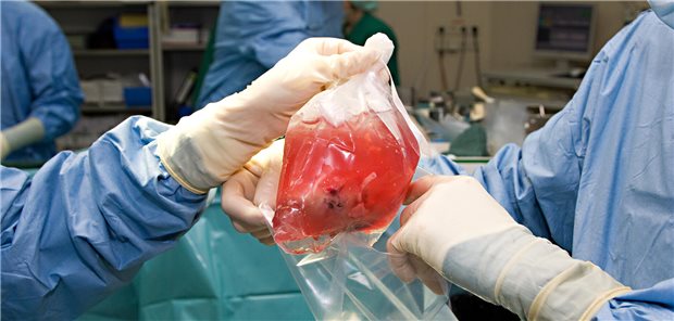 Eine Analyse des UKSH von knapp 20.000 Nierentransplantationen deutet auf Ungerechtigkeiten bei der Vergabe der Spenderorgane hin.