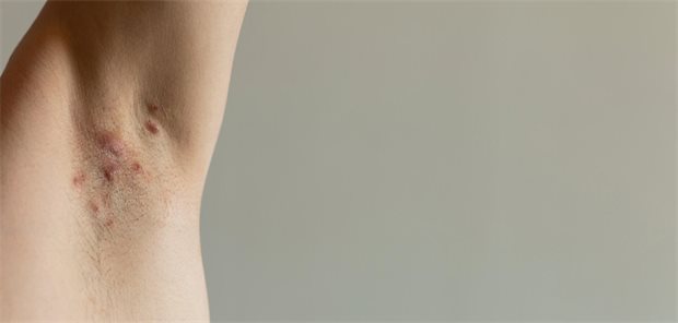 Hidradenitis suppurativa prägt zentrale Lebensentscheidungen Eine Hidradenitis suppurativa schädigt nicht nur die Haut in Bereichen wie Achselhöhlen.