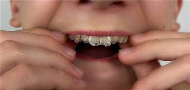 Bruxismus bei Kindern: Wann ist es harmlos – und wann behandlungsbedürftig? Kind setzt sich eine Okklusionsschiene ein