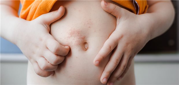 Darauf ist in der Kommunikation mit Skabies-Patienten zu achten Ein Kleinkind kratzt an einem juckenden Ausschlag in der Nabelregion.