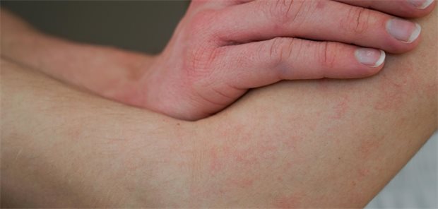 Antihistaminika bringen bei atopischer Dermatitis wohl nichts Eine atopische Dermatitis geht unter anderem mit Juckreiz einher. Laut Leitlinie "Atopische Dermatitis" werden Antihistaminika seit 40 Jahren zur Therapie der atopischen Dermatitis eingesetzt – allerdings ohne ausreichende Belege für ihre Wirksamkeit.