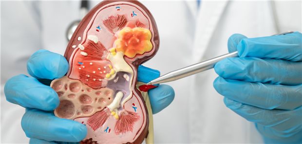 Chronische Nierenerkrankung: Albumin-Kreatinin-Quotient im Urin immer mitbestimmen! Ein Modell der chronischen Nierenerkrankung in den Händen eines Arztes oder einer Ärztin.