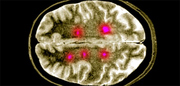 Multiple Sklerose: Kein klarer Vorteil der hochwirksamen Therapie bei Menschen über 52 Jahren Gehirn mit Läsionen von MS