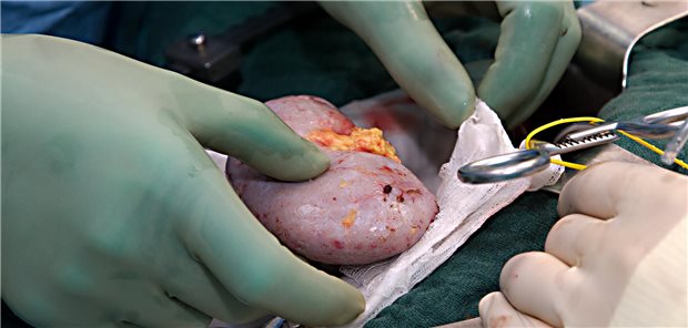 Schnellere Nierentransplantation im Ausland nicht auf Kassenkosten Eine kürzere Wartezeit für eine Nierentransplantation im Ausland bewirkt keine Kostenübernahmepflicht für die GKV.