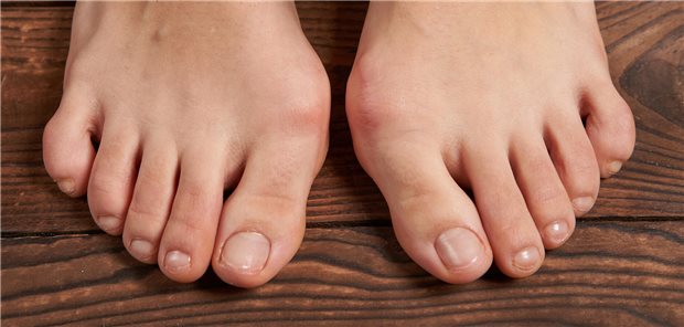 Hallux valgus: Das bedeuten die neuen Leitlinienempfehlungen für Ärzte Nahaufnahme eines Hallux valgus einer Fehlstellung des Fußgelenks bei einer Frau vor einem hölzernen Hintergrund.