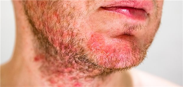 Seborrhoische Dermatitis: Zu welcher Behandlung Experten raten Nahaufnahme des Kinns eines Mannes mit seborrhoischer Dermatitis im Bartbereich.