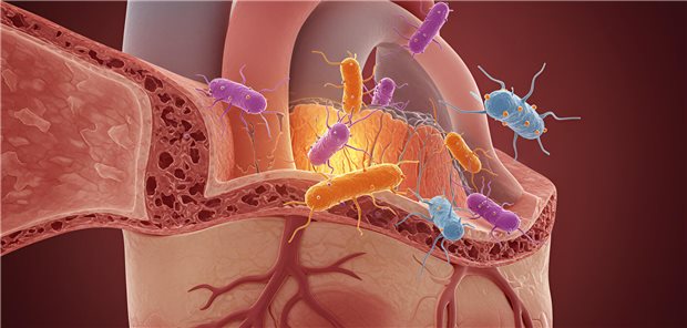 Antibiotika bei infektiöser Endokarditis: Weniger kann reichen Herz mit Bakterien