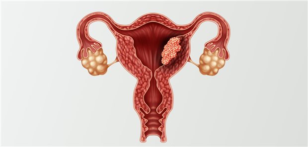 Abbildung Gebärmutter mit Endometriumkarzinom